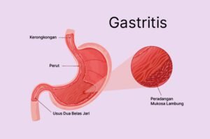 gastritis opini dokter - Artikel Kesehatan Lengkap & Akurat