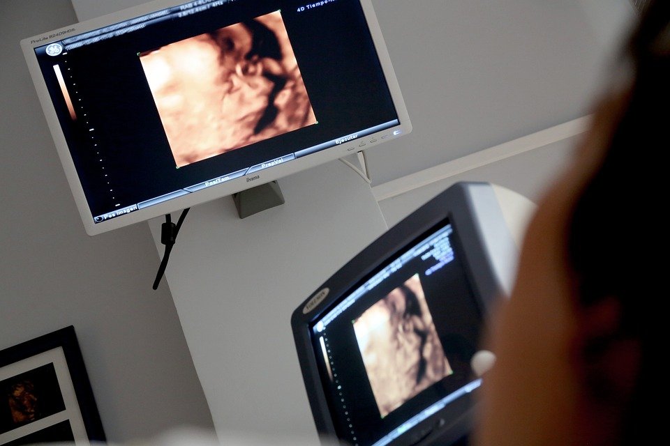 USG program hamil merupakan pemeriksaan yang dilakukan untuk memantau kondisi organ reproduksi wanita yang sedang menjalani program hamil