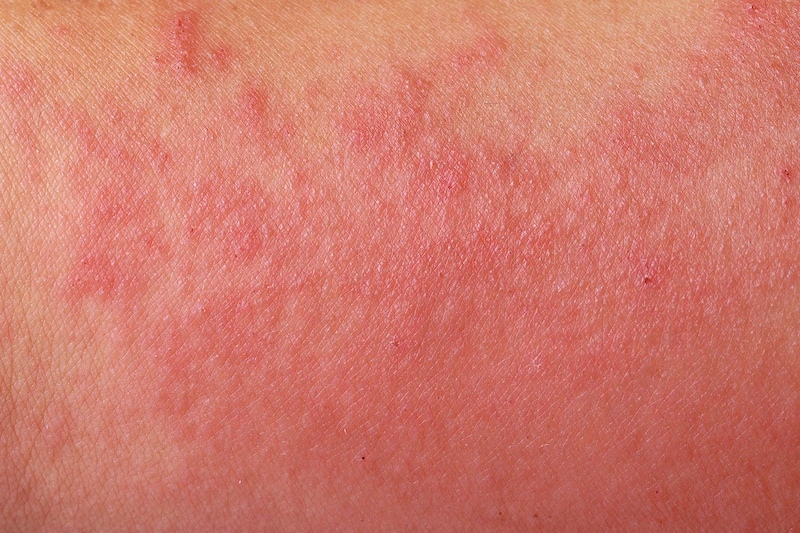 lupus kulit