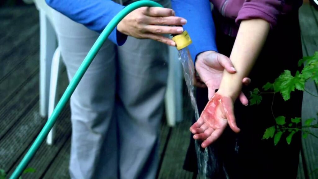 luka bakar air panas